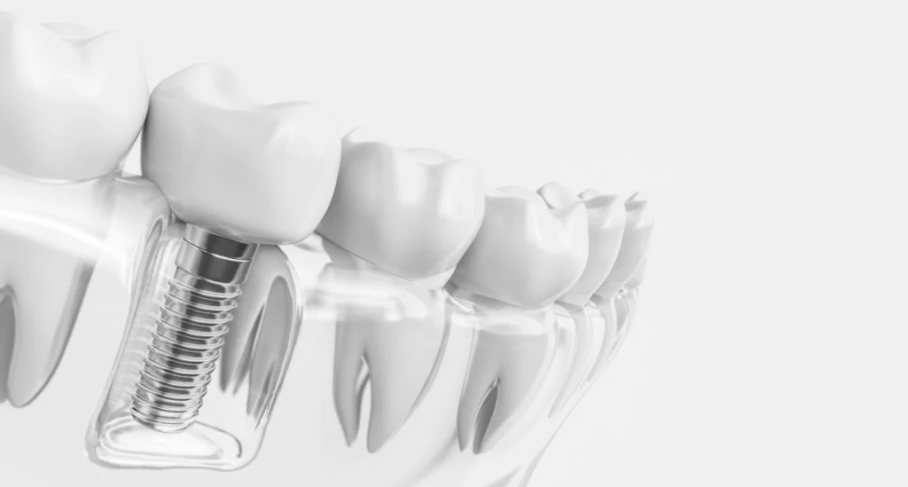 Implant dentaire
