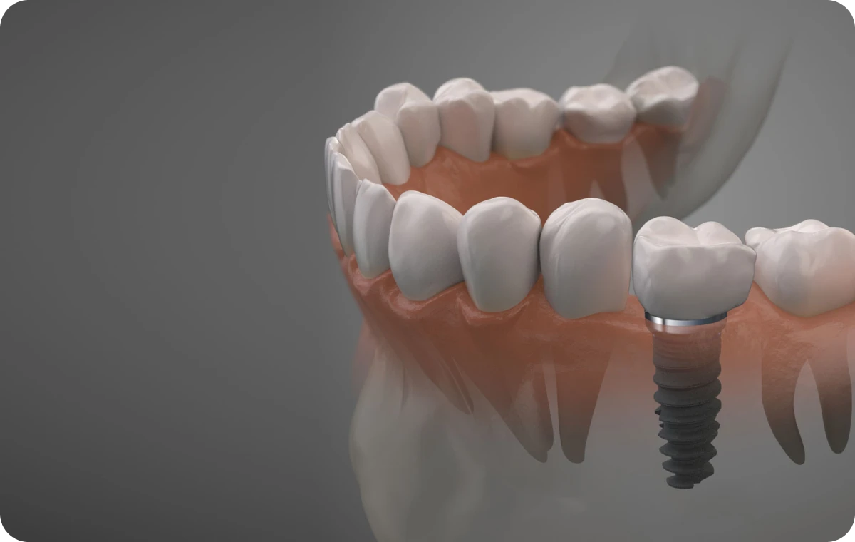 Implant dentaire