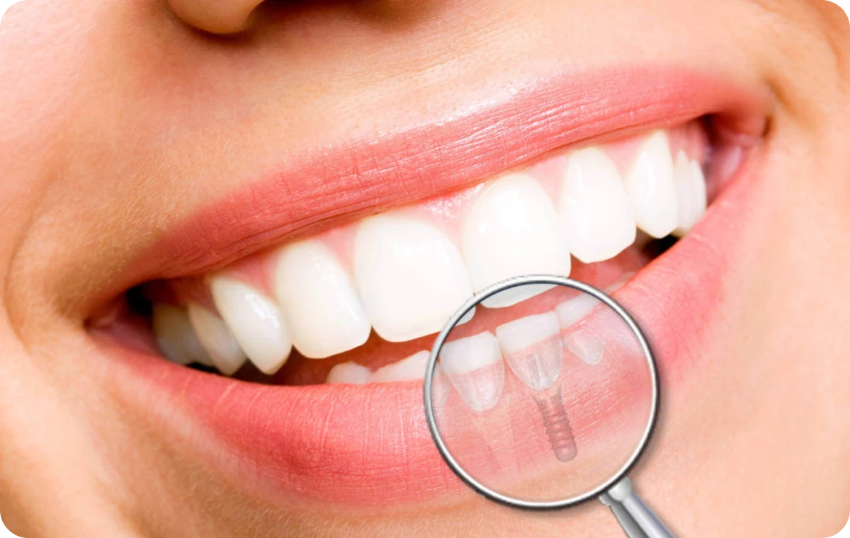 Extraction implantation immédiate