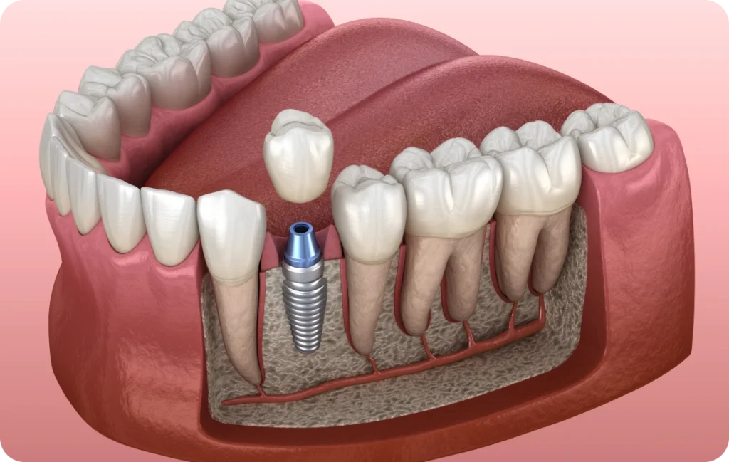 Extraction implantation immédiate