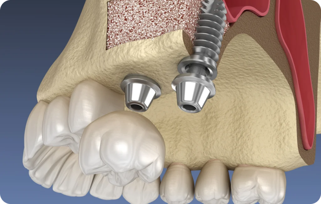 Sinus Lift